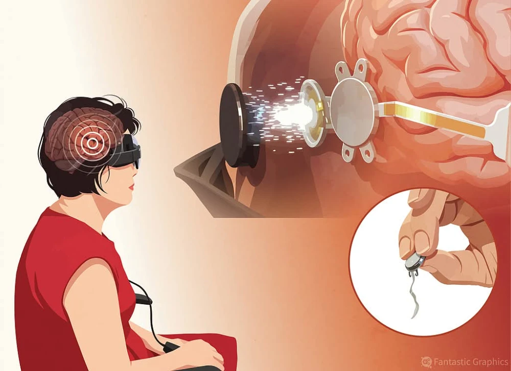 Intelligent Micro Implant Eye